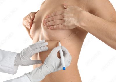 Mammoplastica additiva