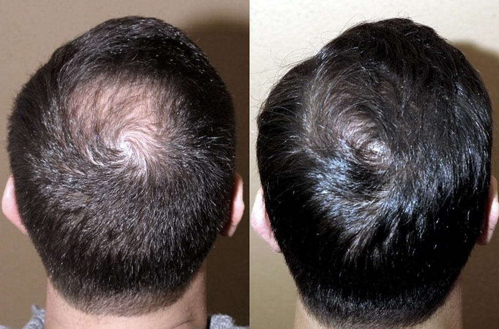 Il Trattamento con le Cellule Staminali