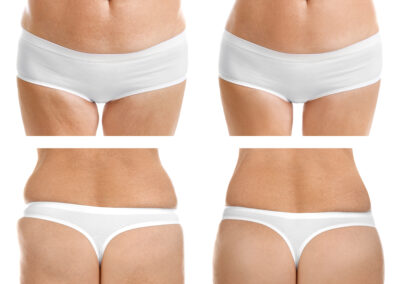 Liposuzione e liposcultura