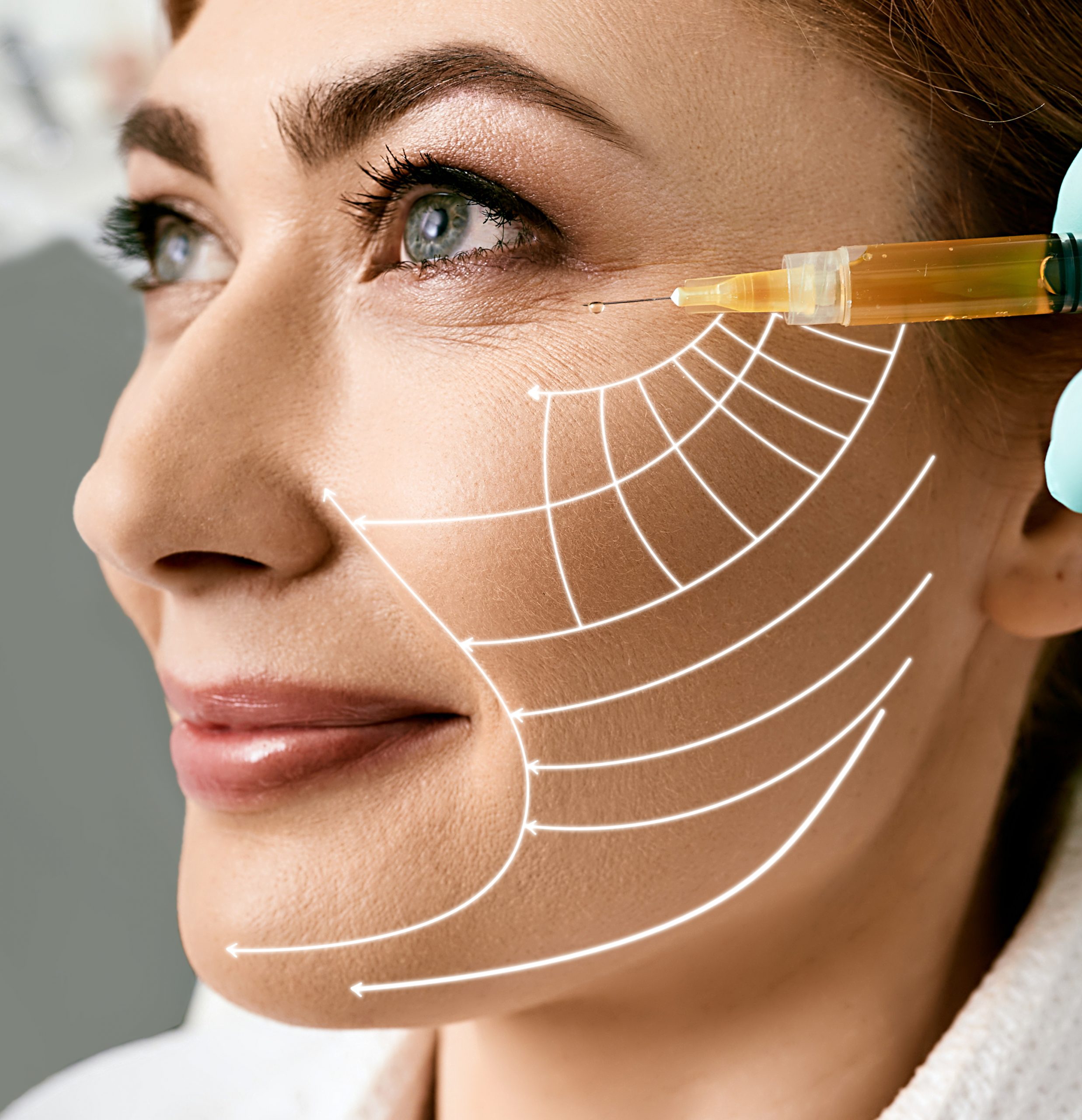 Plasmolifting skin. Middle-aged woman with lifting arrows on her face during plasma therapy