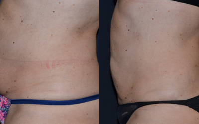 Liposuzione e Bodytite – Dott. Antonio Rusciani Scorza: Prima e Dopo