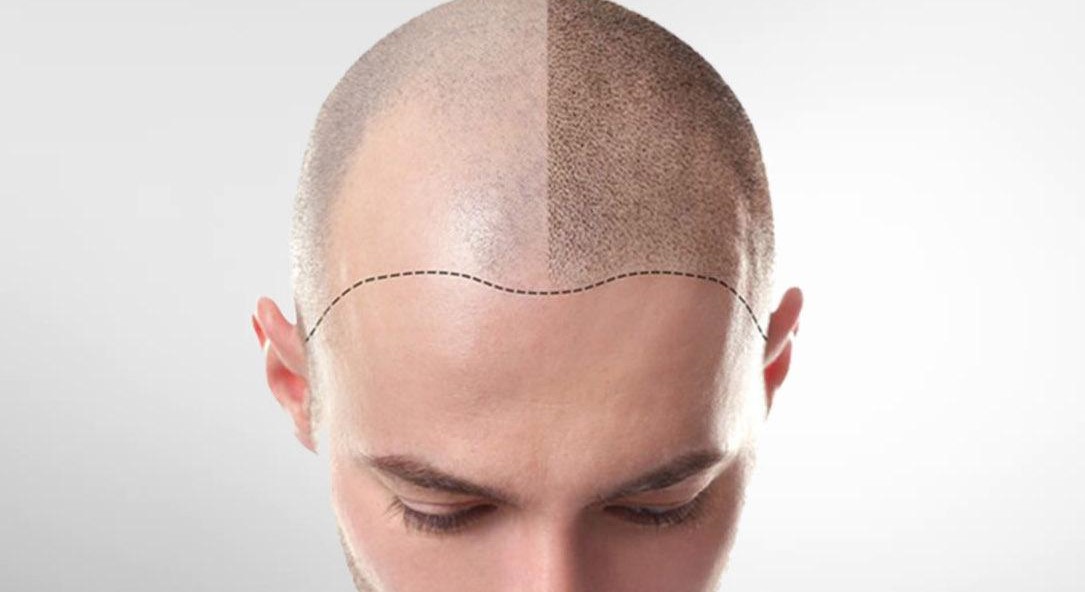 Autotrapianto capelli Roma Nord