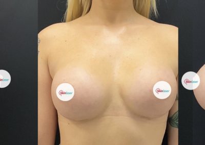 Mammoplastica Additiva1