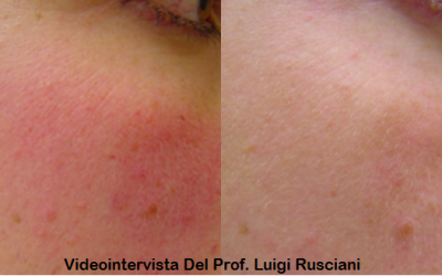 Videointervista del Prof. Luigi Rusciani Scorza sul trattamento di laserterapia per le lesioni vascolari