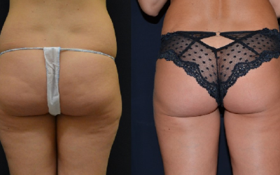 Liposuzione e Bodytite del Dott. Antonio Rusciani Scorza